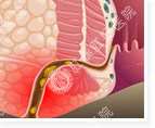 肛瘘有哪些症状？