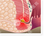 肛瘘有哪些症状？