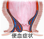 便血一定是大肠癌吗？