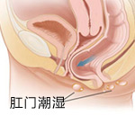 肛门潮湿是怎么回事