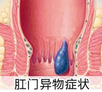 肛门息肉百科