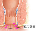 肛门疣病的危害及其预防工作