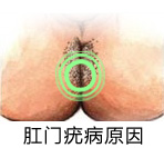 肛门瘙痒形成的原因