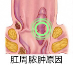 肛周脓肿是怎样形成的？
