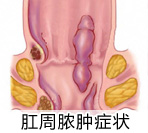 肛周脓肿都有哪些症状