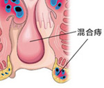 为何女性易患混合痔？