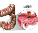 女性结肠炎有哪些症状