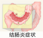 结肠炎是什么病症