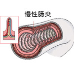 慢性肠炎的日常护理