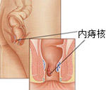 内痔脱出的危害