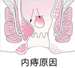 痔疮的原因