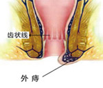 结缔组织外痔症状及原因