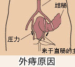 什么是外痔？