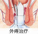 哪种情况下外痔是需要手术的