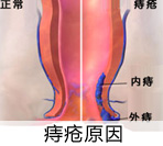 痔疮是什么原因造成的