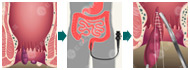 肛肠吻合器手术优势
