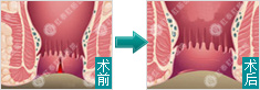 肛瘘手术前后对比