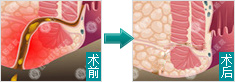 肛瘘手术前后对比