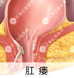 痔疮较佳治疗方法