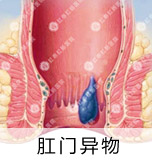 痔疮较佳治疗方法