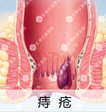 肛肠吻合器创口微小微痛 治疗痔疮无需开刀