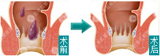 痔疮手术前后对比