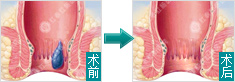 肛瘘手术前后对比