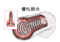 慢性肠炎百科