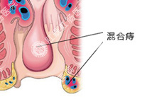 混合痔百科