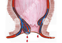 便血百科