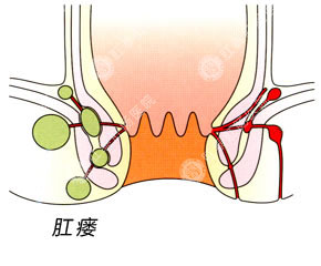 得了肛瘘会有什么症状