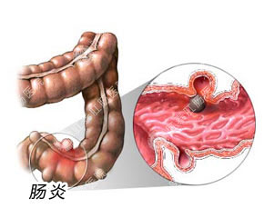 慢性肠炎的症状