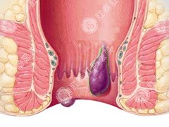 得了痔疮怎么办